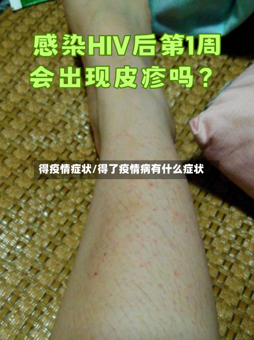 得疫情症状/得了疫情病有什么症状-第1张图片